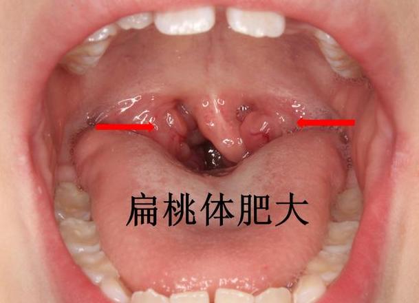腺样体肥大的天然克星